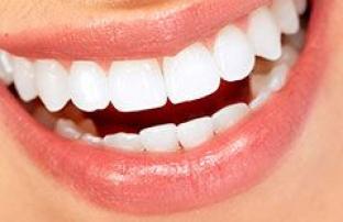 Teeth Whitening: What Are My Options?